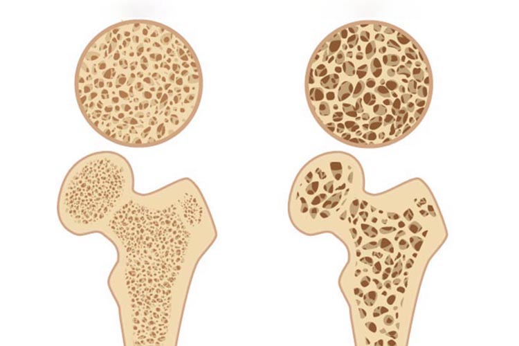 骨粗しょう症イメージ画像